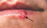Cómo deshacerse de las ampollas de fiebre en la cara, lengua, labios y boca