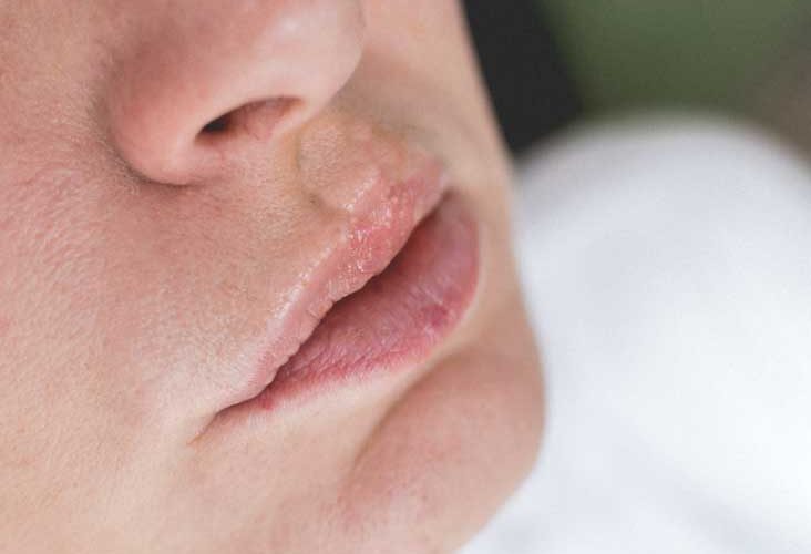 Cómo deshacerse de las ampollas por quemaduras solares en la nariz, la cara, los labios y la piel rápidamente