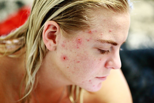 Cómo deshacerse del tejido cicatricial en la cara