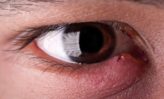Cómo tratar la infección ocular naturalmente en casa