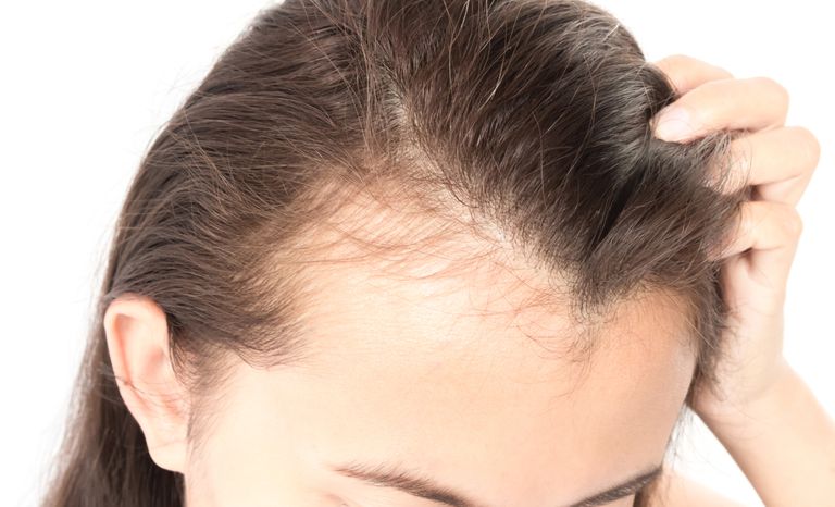 como tratar la alopecia