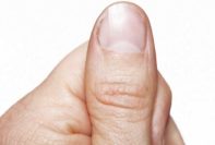 consejos para detener la punción de la piel en el cuero cabelludo, los dedos y alrededor de las uñas