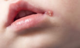 cómo deshacerse de las aftas dolorosas de garganta, encías, lengua y labios