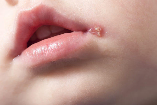 cómo deshacerse de las aftas dolorosas de garganta, encías, lengua y labios