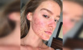 cómo deshacerse de las cicatrices de la varicela en la cara
