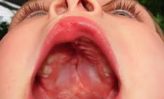 ¿Qué causa las aftas en las encías y la garganta?