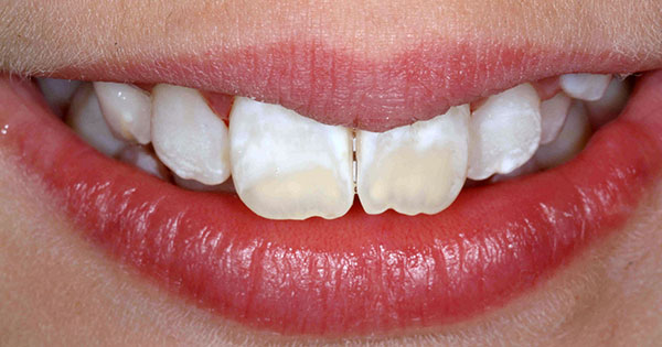 maneras de eliminar las manchas blancas de los dientes