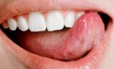 remedios caseros para el herpes labial en los labios y en la boca