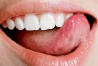 remedios caseros para el herpes labial en los labios y en la boca