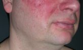 remedios caseros para la erupción por rosácea en la piel facial y corporal