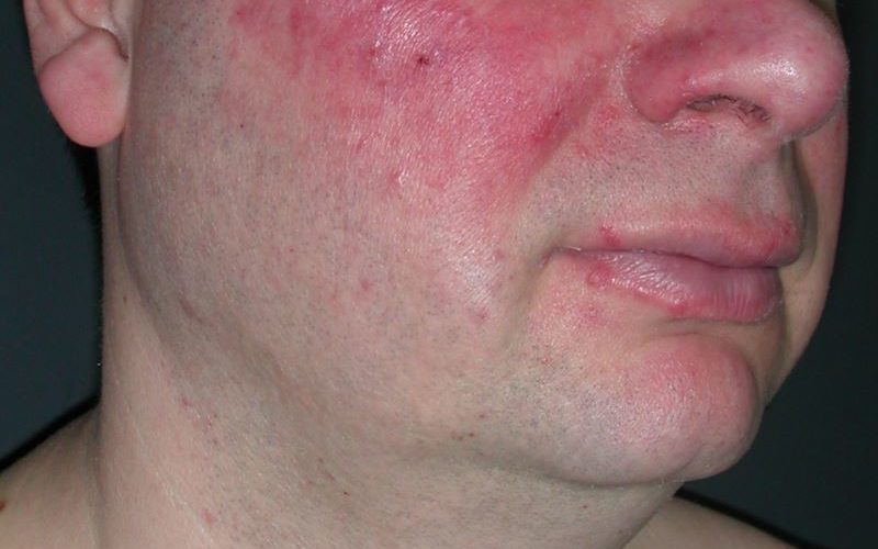 remedios caseros para la erupción por rosácea en la piel facial y corporal