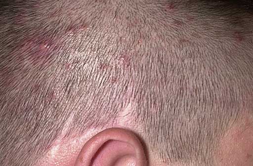 tratar la foliculitis en la cara y el cuero cabelludo