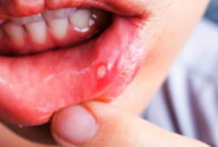 tratar las encías inflamadas alrededor de los dientes y las mejillas con pus